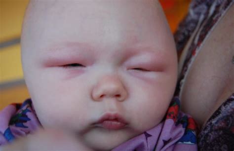 Baby With Puffy Eyes Causes Treatments And Remedies Skincarederm