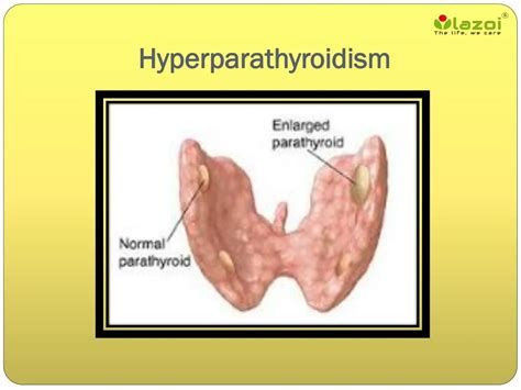 PPT Hyperparathyroidism Symptoms Causes And Treatment PowerPoint
