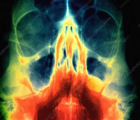 Sinus Polyp Facial X Ray Stock Image M2400383 Science Photo Library