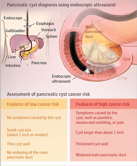 Diagnosis And Treatment Of Pancreatic Cystic Neoplasms