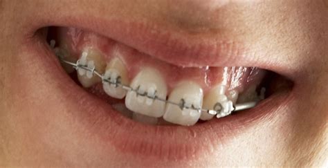 Buck Teeth Need Correction As They Can Cause Long Term Dental Issues