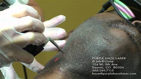 Begin to enjoy hairless smooth skin in just a few treatments. Dark Skin Laser Hair Removal - YouTube
