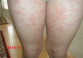 No rash is specific to hiv, but a rash can be an early sign of infection. Mild Hiv Rash | Excellent Health Information |Healthy Web M.D.