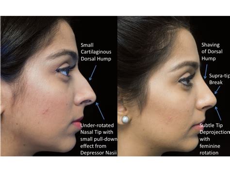 What Is Closed Rhinoplasty Closed Rhinoplasty For Bulbous Nose Tip