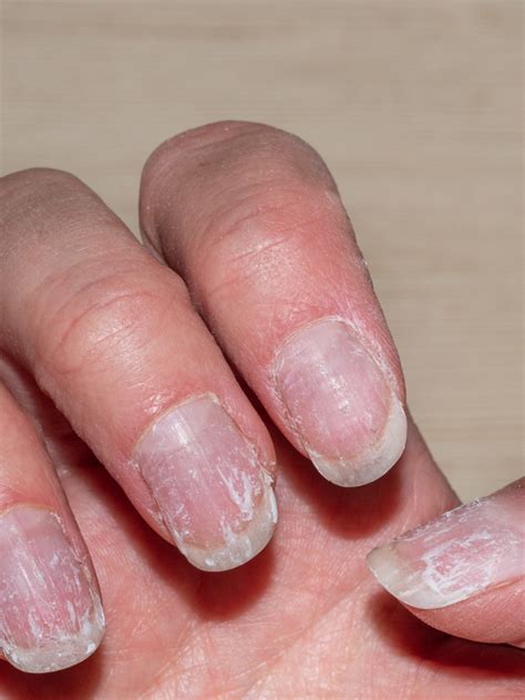 8 Diseases That White Spots On Your Nails Indicate Times Of India