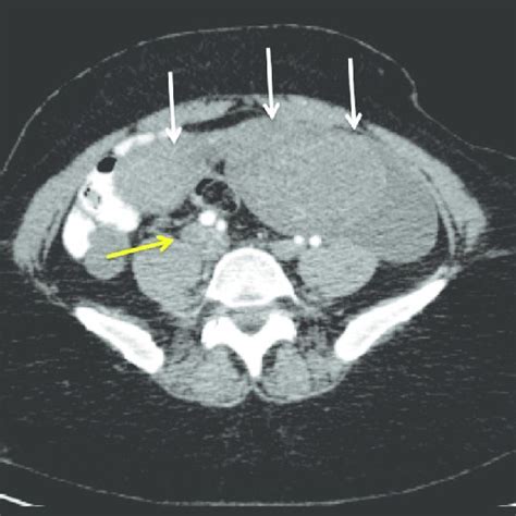 Axial Contrast Enhanced Ct Scan Of The Abdomen And Pelvis Revealed A