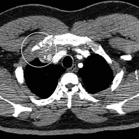 Computed Tomography Of The Chest Showed A 3 Cm Mass Abutting The Right