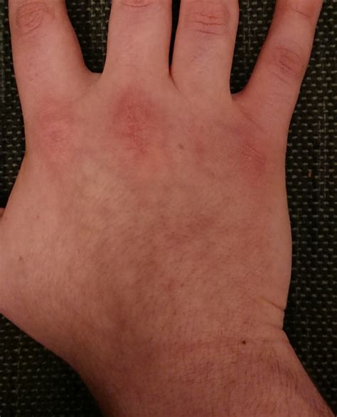 Year Long Rash On Back Of Hand Dermatology Forums Patient