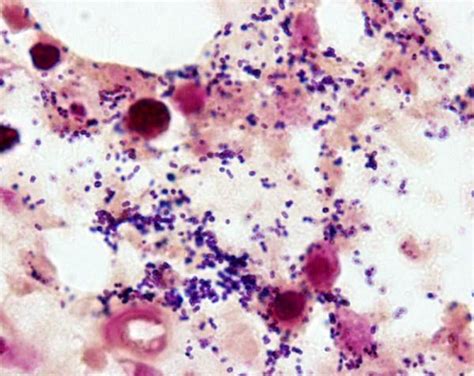 Streptococcal infections, such as strep throat; A clinical sample that has been Gram-stained. Note the ...