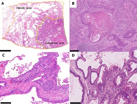 Representative Histological Features Of Lung Cancer In A Patient With