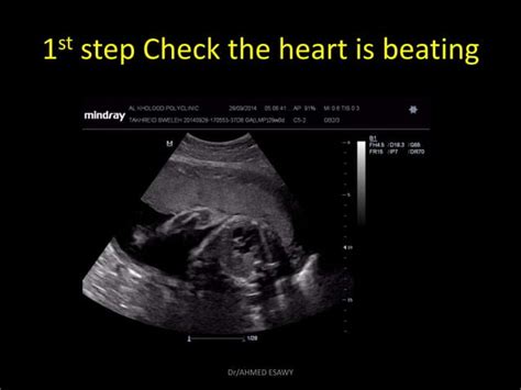 2 Fetal Echo Part 1 Dr Ahmed Esawy