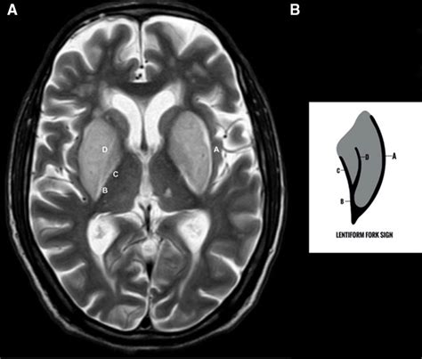 Lentiform Fork Sign In Uraemic Encephalopathy Bmj Case Reports