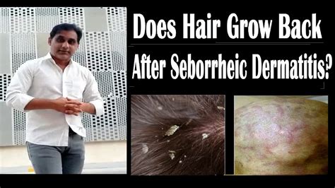 Atopic Dermatitis Hair Loss Seborrheic Dermatitis Hair Loss Natural