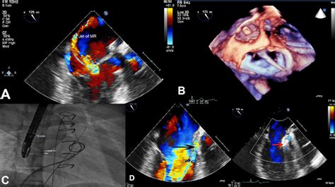 Panel A Tee Showing Severe Mitral Regurgitation Through The Aml