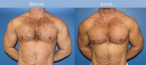 Heres Why Theres A Huge Boom In Men Getting Plastic Surgery Sfgate
