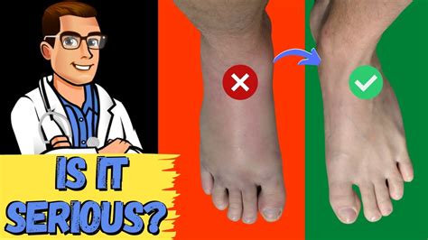 How To Tell If My Foot Or Ankle Injury Is Bad Sprained Or Broken
