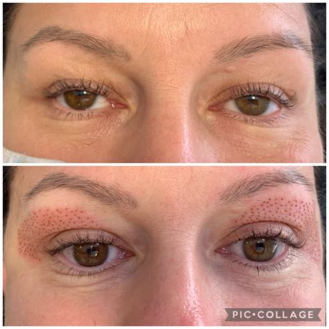 Non Surgical Plasma Eye Lift High End Treatments Bella Goode Hair Beauty Training Academy