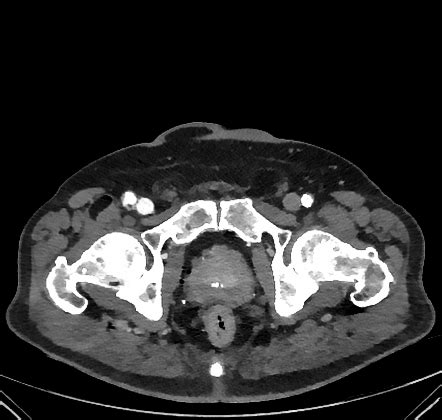 Arteriovenous Fistula Radiology Case Radiopaedia Org