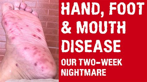 Hand Foot And Mouth Disease Documentary Our Two Week Nightmare