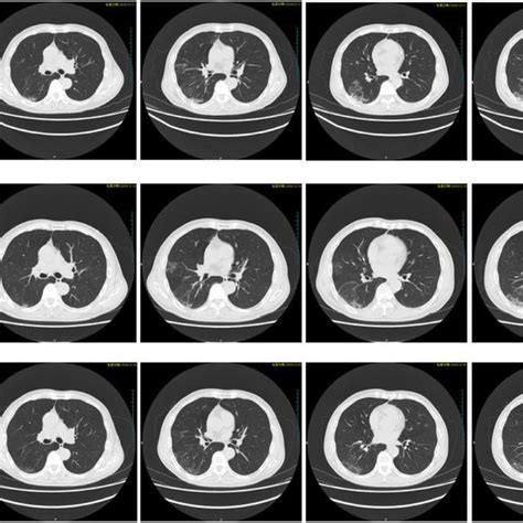 Ct Scans Of The Chest Of Patient 2 Chest Ct Images Showed Bilateral