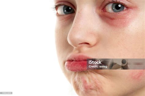 Allergic Reaction Skin Rash Close View Portrait Of A Girls Face Redness