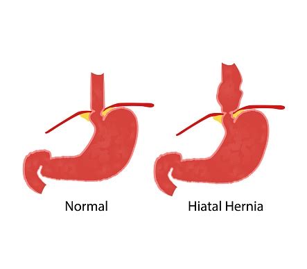 What You Need To Know About Hiatal Hernias Dr Malladi
