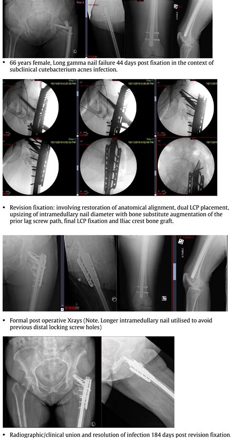 Proximal Femur Fracture Non Union With Or Without Implant Failure A