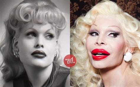 Amanda lepore's botched plastic surgery fails. Lip augmentation of Amanda Lepore | Amanda lepore, Extreme ...