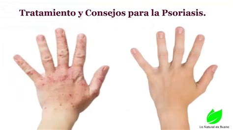 Tratamientos Y Consejos Para La Psoriasis Youtube