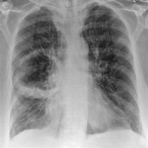 Lung Abscess Radiology Reference Article