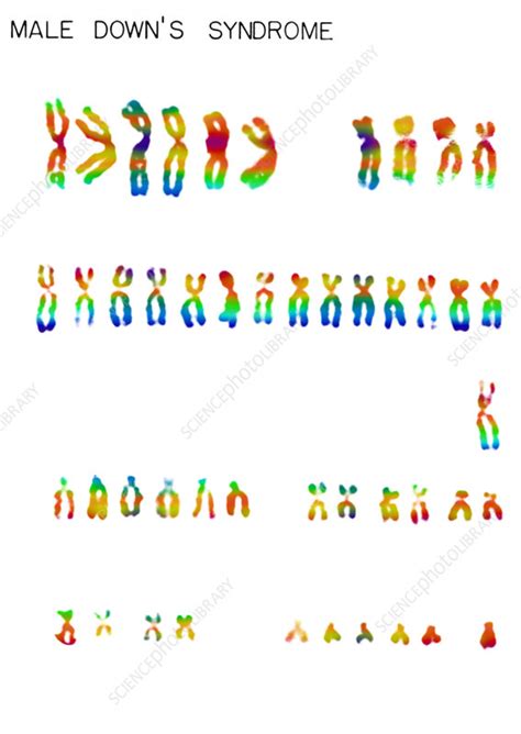 Downs Syndrome Karyotype Stock Image C0220521 Science Photo Library