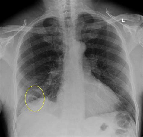 Cureus Cavitary Pulmonary Infarction In A Case Of Pulmonary Embolism