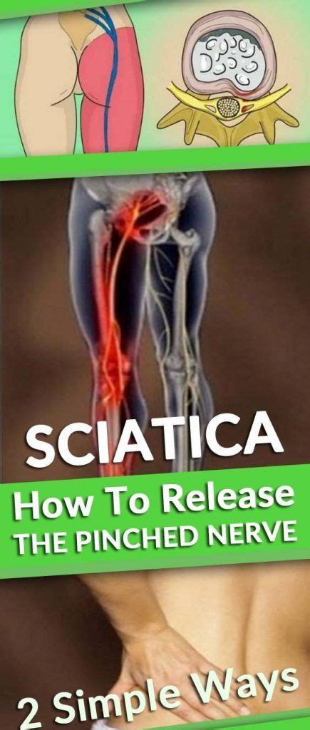 Pin On Sciatica Pain And Back Pain Treatment