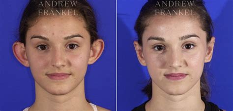 Otoplasty Before And After Photos Andrew S Frankel Md