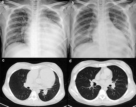 Radiogical Examination A B A Chest Radiograph Of A Child Patient
