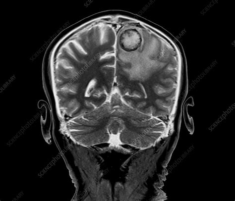 Secondary Brain Cancer Mri Scan Stock Image C0403195 Science