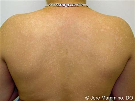 White Spots On Back Core Plastic Surgery