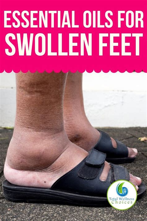 Natural Remedies For Swollen Feet And Ankles