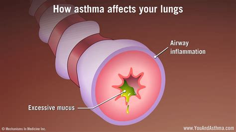 how asthma affects your lungs asthma inflames the airways so they produce more mucus than