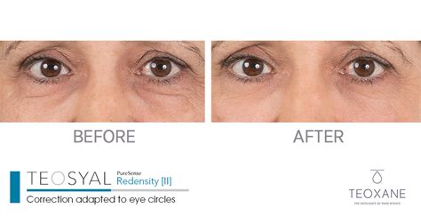 Fix Sunken Eyes With Redensity® 2 Filler In Canada — Myrha Beauty