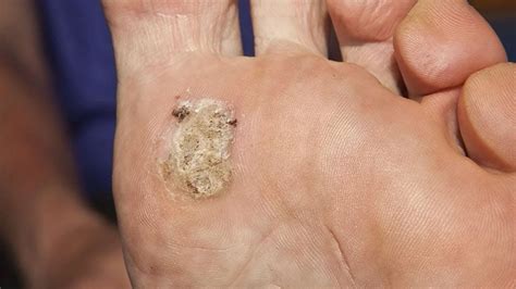 Medical Doctors Discuss Plantar Wart Removal Youtube