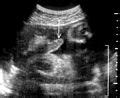 Category Ultrasound Images Of Fetal Penis Wikimedia Commons