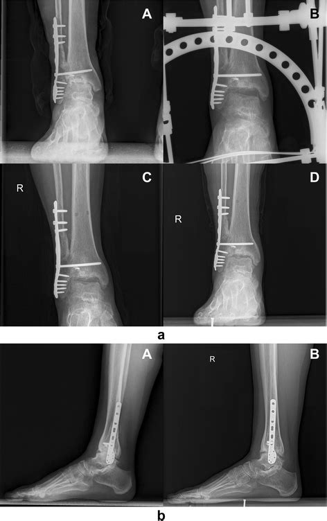 Ankle Joint Distraction Arthroplasty For Severe Ankle Arthritis Bmc