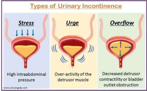 Urinary Incontinence Ui Classification Management We Care