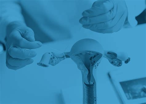 Laqueadura Tubária Pode Engravidar