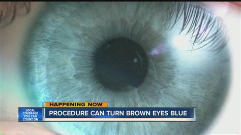 Procedure Can Turn Brown Eyes Blue Youtube