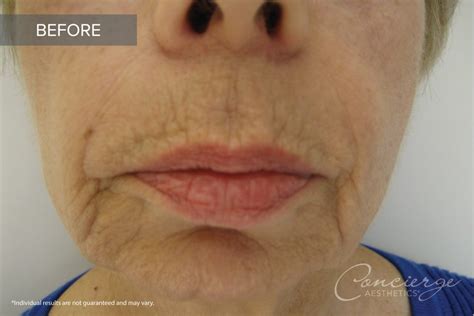 Before And After Photos Juvederm In The Lips Concierge Aesthetics