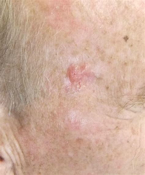 Disease Management Nonmelanoma Skin Cancer