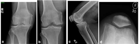X Ray Showed Severe Medial Compartment Arthritis With Bone Loss A