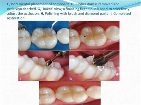 What Is A Resin Composite 2s Posterior Sportcarima